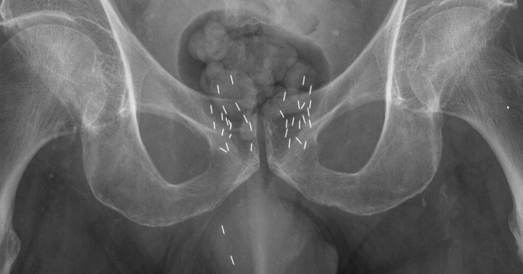 Braquiterapia: como funciona a “radioterapia...