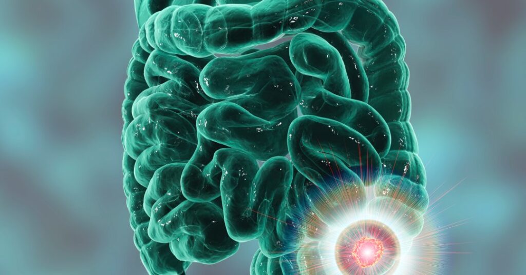 Câncer de intestino cresce entre adultos jovens. Por quê?