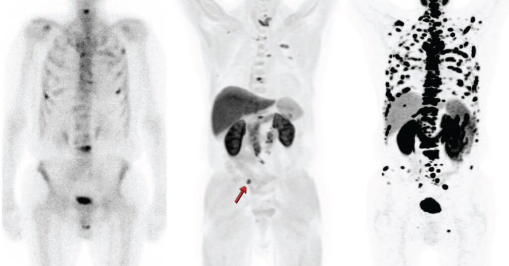 PET-CT com PSMA: revolução no diagnóstico e tratamento do câncer de próstata