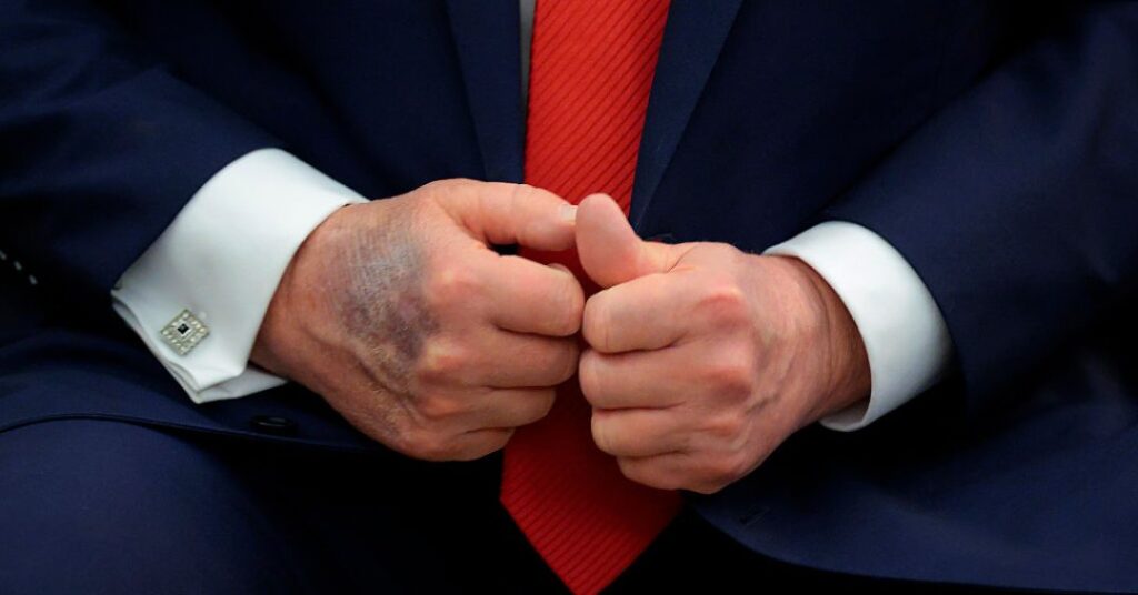 Donald Trump aparece com hematomas e maquiagem nas mãos