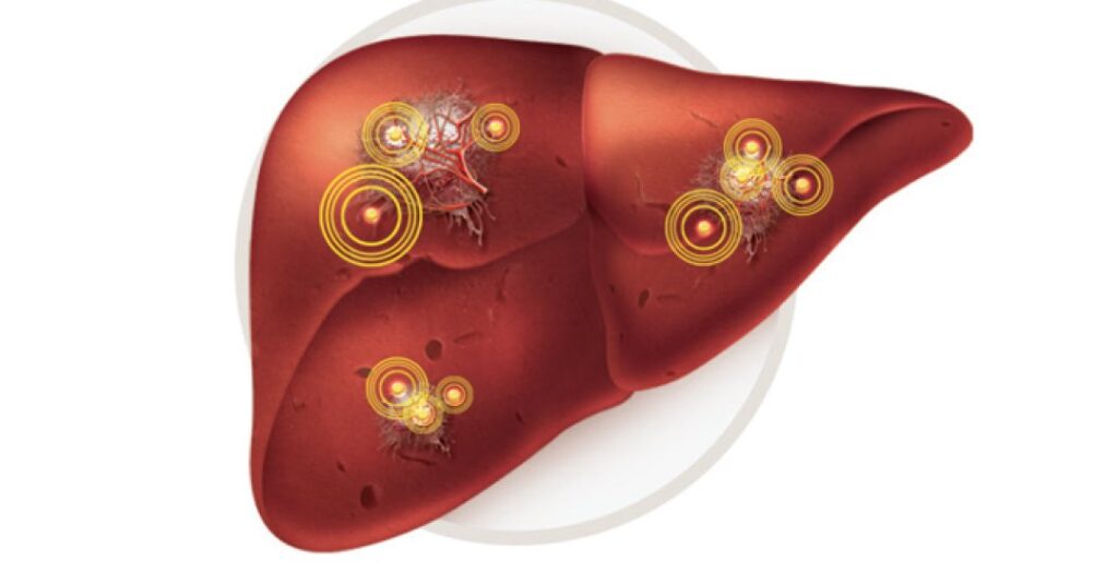 Hepatite D: conheça a “superinfecção” do fígado