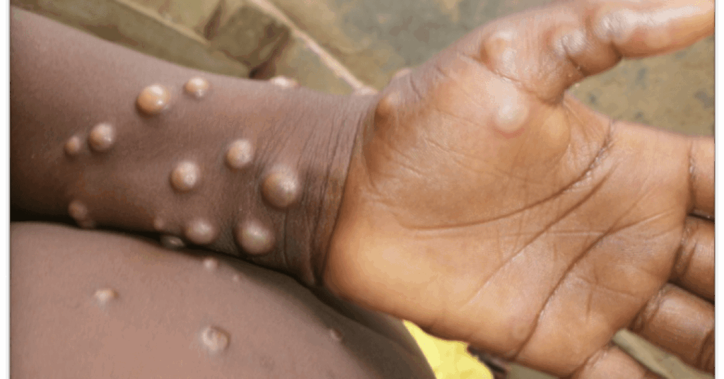 Brasil registra 2º caso de cepa mais letal do Mpox; saiba as chances de surto no país
