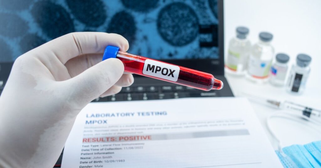 Mpox supera 80 casos no Brasil e novo estado é afetado