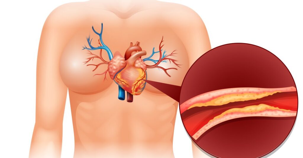 Aterosclerose: o que é, sintomas e tratamento