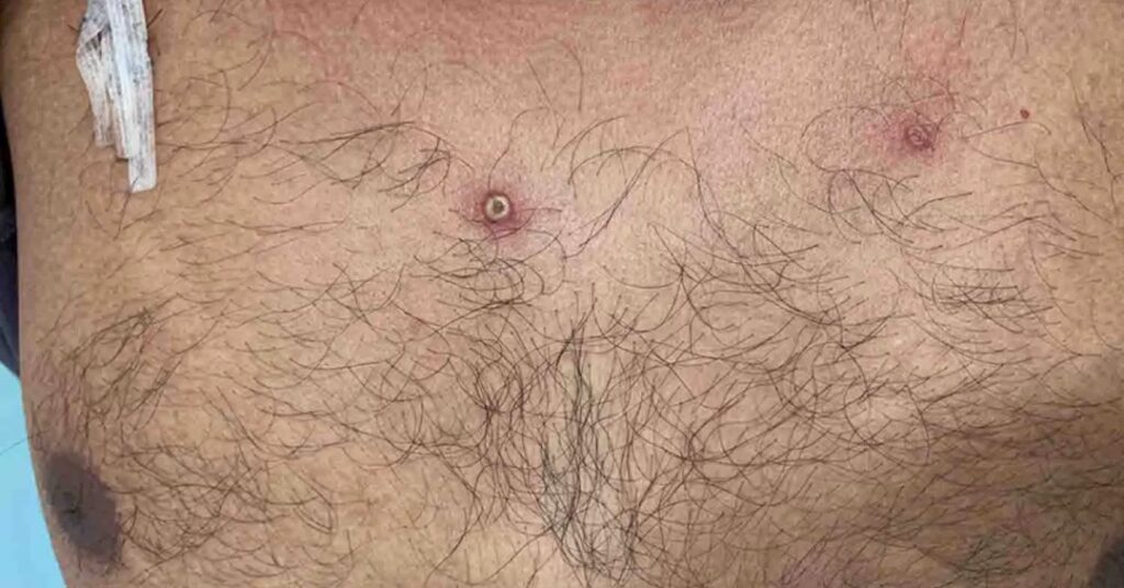 Mpox: é preciso usar máscaras? Como prevenir? Quais os sintomas? Tire dúvidas