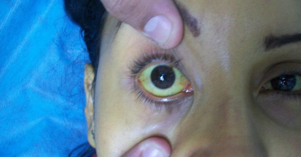 Olhos amarelados: conheça doenças que podem levar ao sintoma