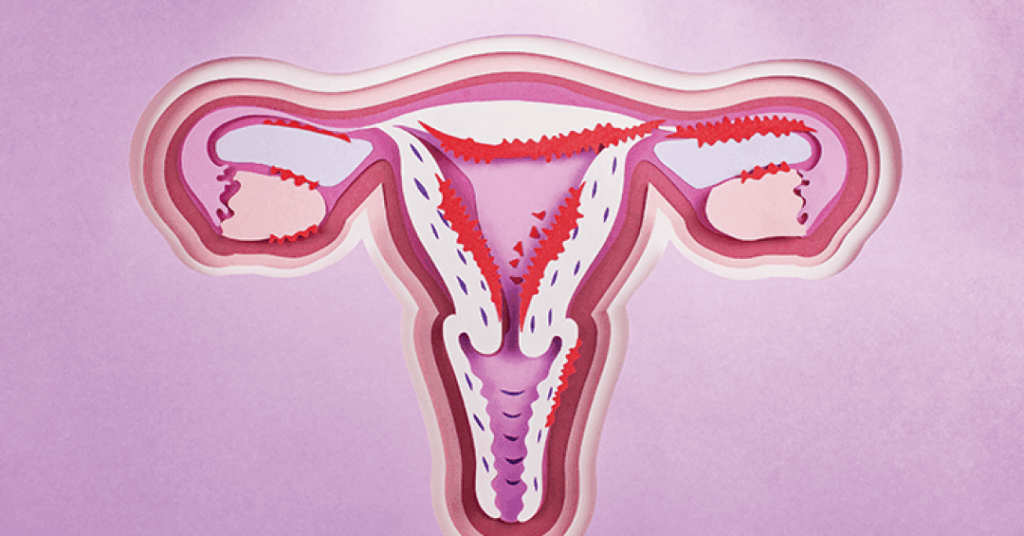 Endometriose: brasileiras esperam quase 4 anos pelo diagnóstico