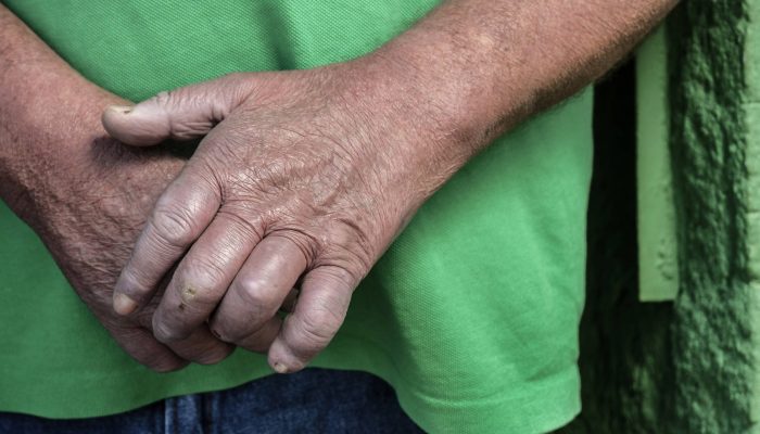 Infecções por hanseníase despencam no Brasil em 11 anos - 25/01/2026 - Equilíbrio e Saúde