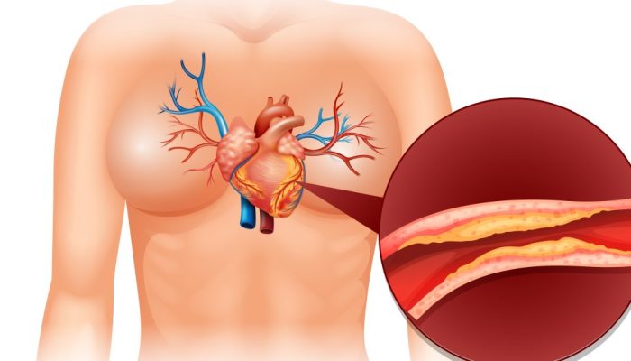 Aterosclerose: o que é, sintomas e tratamento