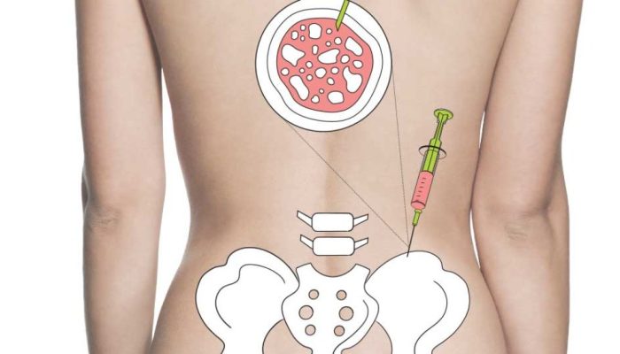 Medula óssea: o que é necessário para se tornar doador no Brasil