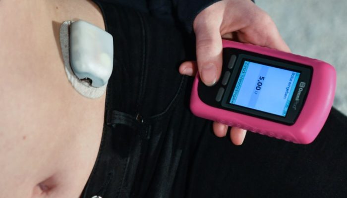 Bomba de insulina para quem tem diabetes tipo 1: entenda decisão do STJ