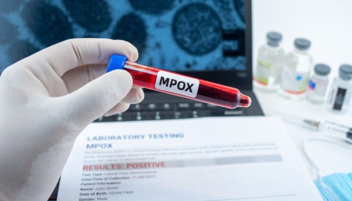 Mpox supera 80 casos no Brasil e novo estado é afetado