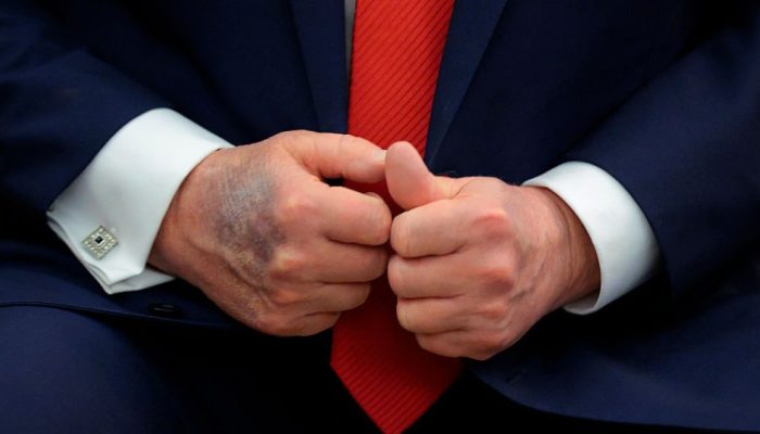 Donald Trump aparece com hematomas e maquiagem nas mãos