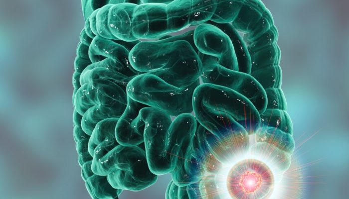 Câncer de intestino cresce entre adultos jovens. Por quê?