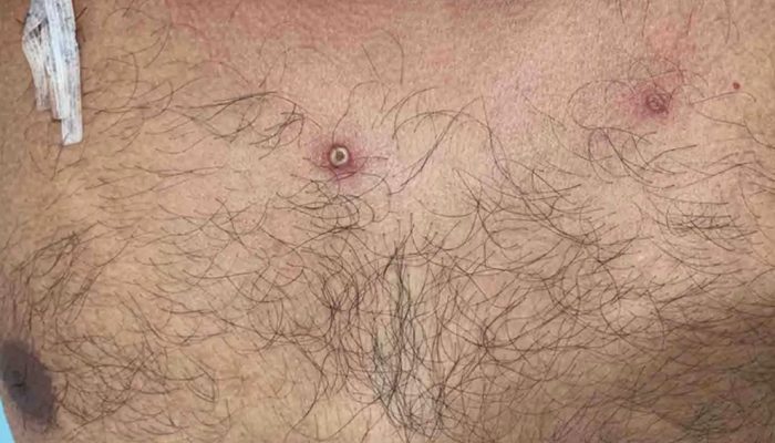 Mpox: é preciso usar máscaras? Como prevenir? Quais os sintomas? Tire dúvidas