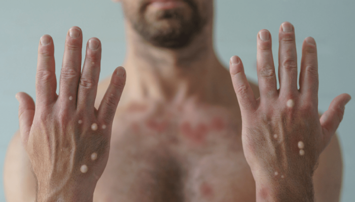 Nova variante do Mpox: o que se sabe sobre vírus confirmado pela OMS?