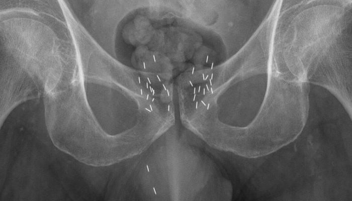 Braquiterapia: como funciona a “radioterapia...