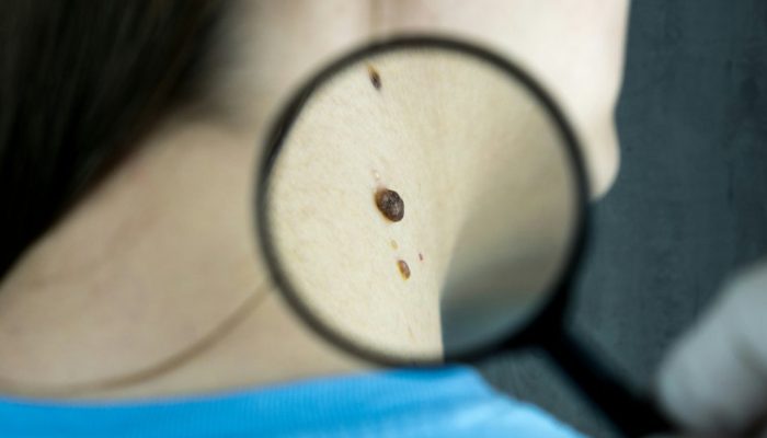 Como age a nova vacina contra o câncer de pele mais agressivo