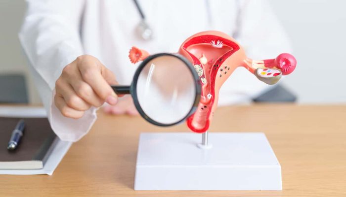 Comer carne vermelha pode aumentar risco de endometriose em até 56%