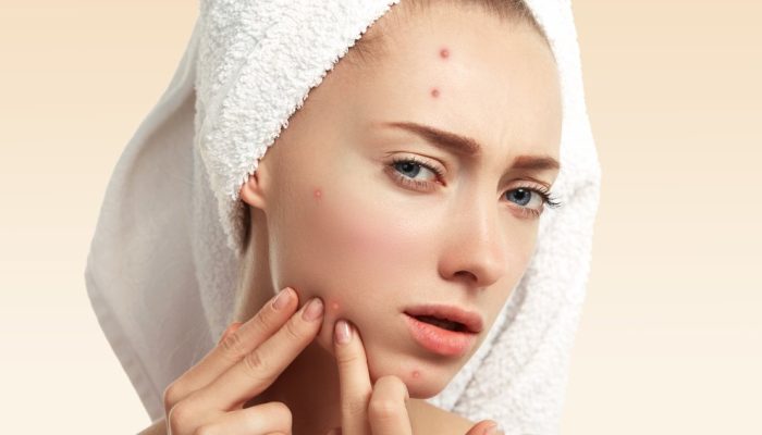 Espinhas inflamadas: o que acontece se você espremer?