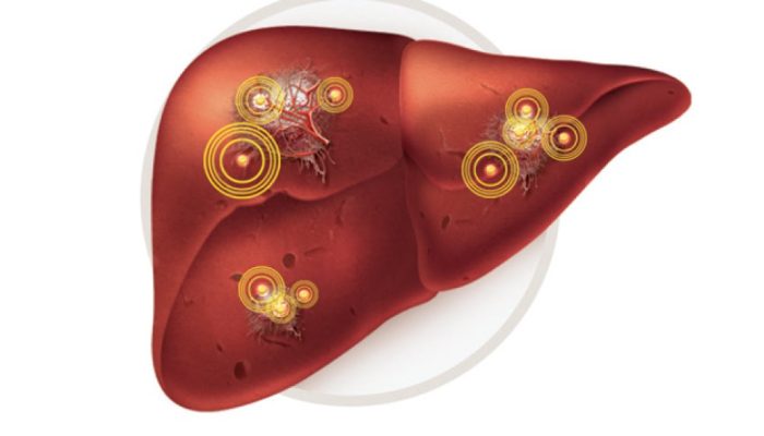 Hepatite D: conheça a “superinfecção” do fígado