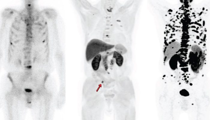 PET-CT com PSMA: revolução no diagnóstico e tratamento do câncer de próstata
