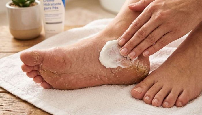Técnica oculta pra hidratar os pés com creme e meia pra acabar com as rachaduras no calcanhar
