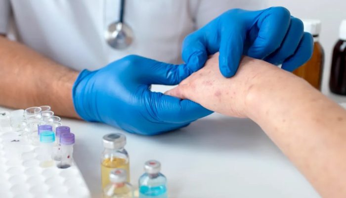 Brasil se aproxima de 150 casos de mpox em 2026; veja os estados com aumento