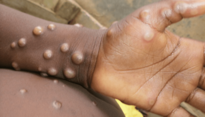 Brasil registra 2º caso de cepa mais letal do Mpox; saiba as chances de surto no país