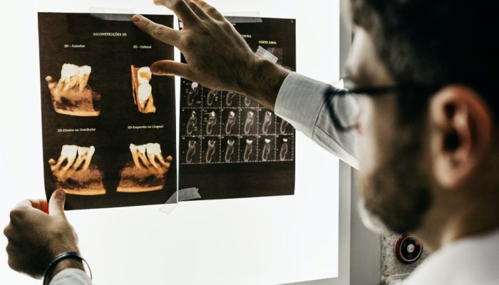Exercício e ômega-3 podem aliviar infecção na raiz do dente, diz estudo brasileiro