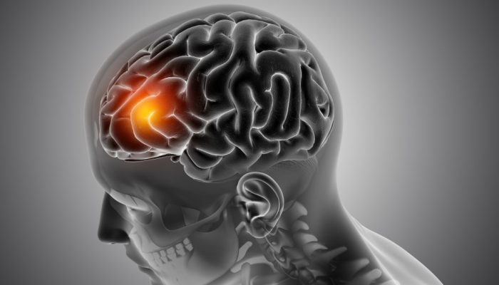 Trombose cerebral: o que é, quais os sintomas e tratamentos